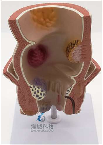 直肠病理模型