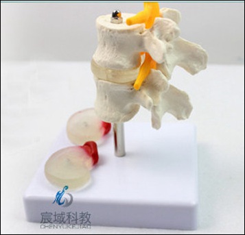 CY-GG055 2节腰椎附2个病变椎间盘模型