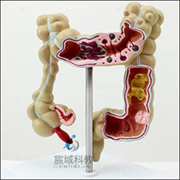 大肠病变模型