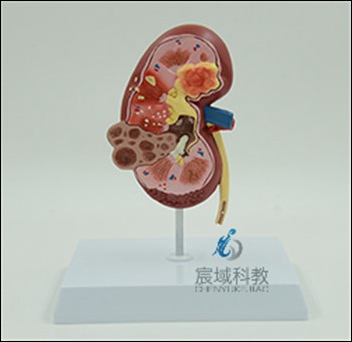 肾脏正常及病变模型