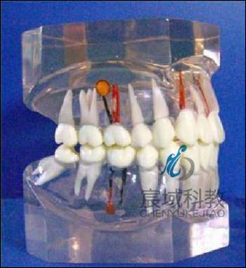 CY-KQ043 透明牙体病理模型