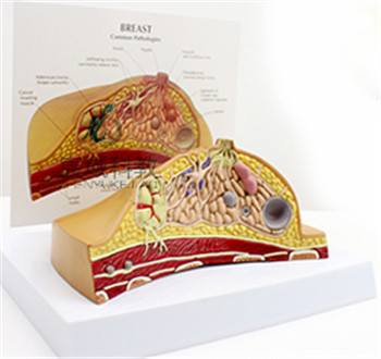 乳房病理解剖模型