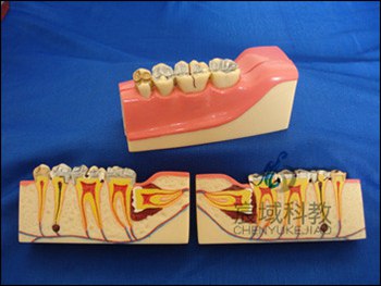 CY-KQ013  右下后牙组织分解模型