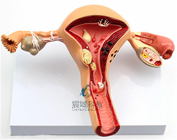 子宫、卵巢病理模型