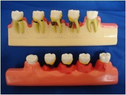 CY-KQ012 2倍牙周病进展模型