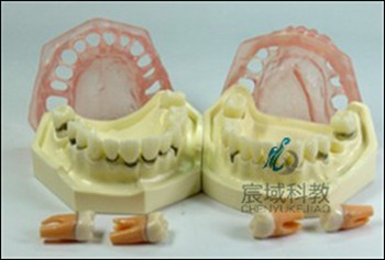 CY-KQ046 牙周病模型